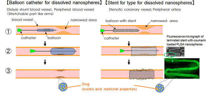 Balloon catheter for dissolved nanospheres Stent for type for dissolved nanospheres